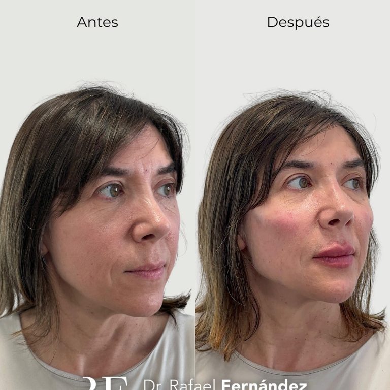 Bioestimuladores de colágeno