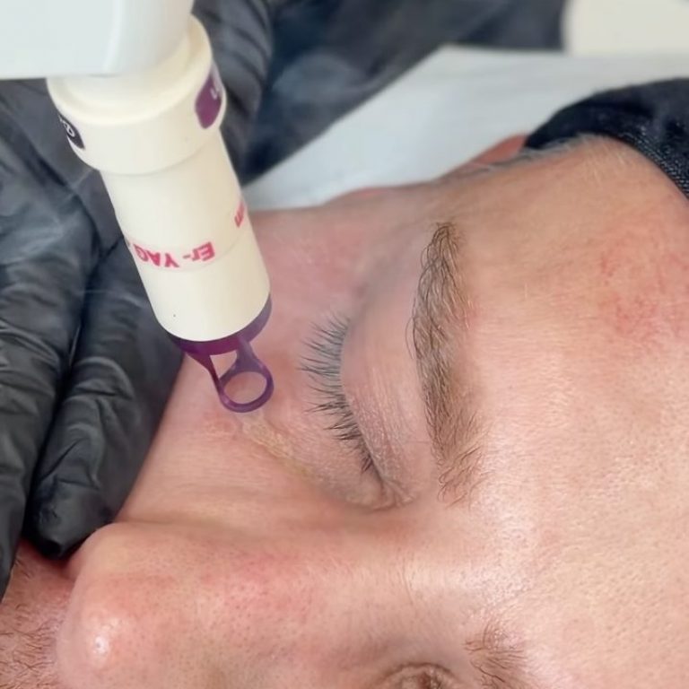 Rejuvenecimiento Facial con Láser en Barcelona
