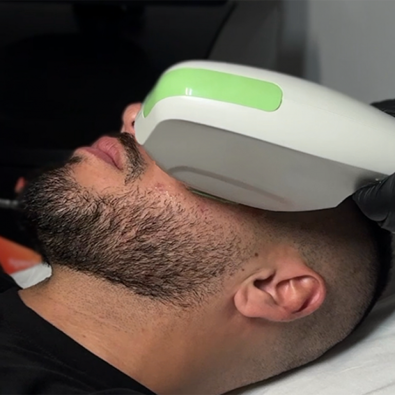 Tratamiento con Láser para manchas