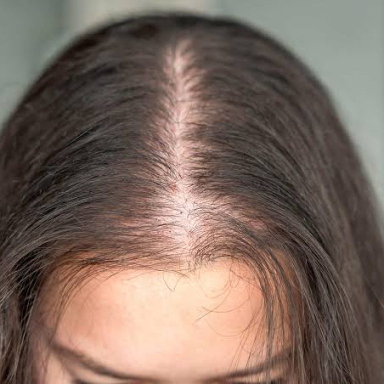 Tratamiento para la Caída del Pelo en Mujeres