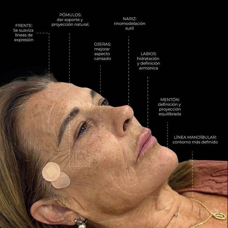 armonización facial