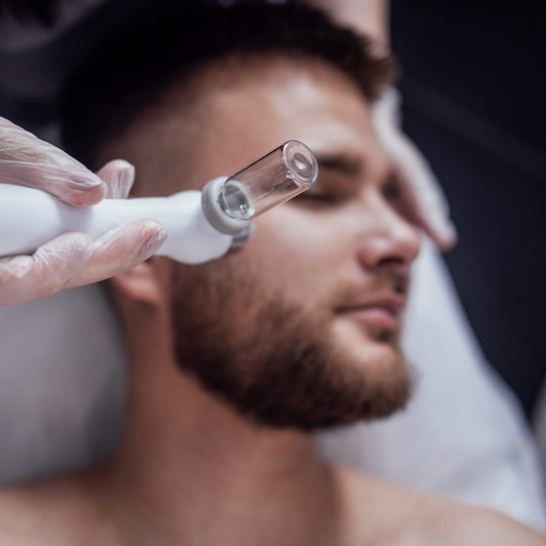 Peeling Químico Facial