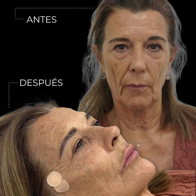 tratamiento para la flacidez facial